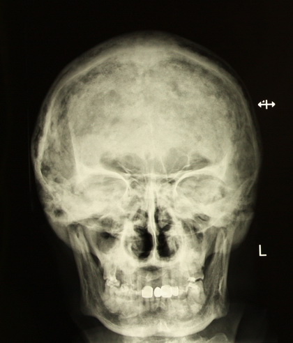 Костная болезнь Педжета: череп