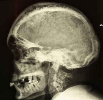 Костная болезнь Педжета: череп