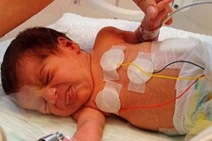 Кардиостимулятор был имплантирован только что родившейся девочке
