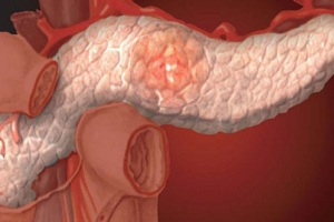 Начинаются клинические испытания нового средства от рака поджелудочной железы