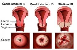 endometrium rák 2. stádium)