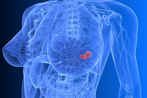 Длительный прием блокаторов кальциевых каналов увеличивает риск развития рака груди