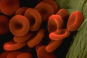 Простой компьютерный тест покажет риск развития фатальной тромбоэмболии